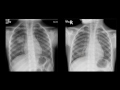 cases in radiology episode 3 pediatric chest x ray