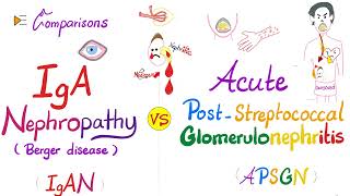 IgA Nephropathy (IgAN) vs Acute Post-Streptococcal Glomerulonephritis (APSGN)