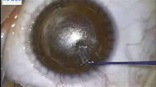 Small-Incision Lenticule Extraction (ReLEx SMILE)