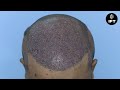 hair patch in jaipur non surgical hair replacement u0026 cost details ift hair science