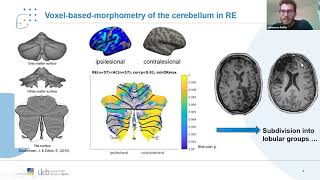 Talk: Volumetric analysis reveals bilateral cerebellar atrophy in Rasmussen encephalitis