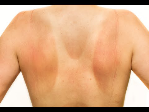 How to Relieve Pain from Sunburn How to Relieve Pain from Sunburn