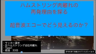 ハムストリング近位肉離れ　再発する理由を探る！　経過1ヶ月超音波エコー観察