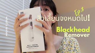 รีวิวเครื่องดูดสิวเสี้ยนCBG Devices | WHAT'S REVIEW EP.8