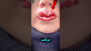 أرادت شفاه مثيرة ولكن ما حدث كان غير متوقع 💋😱