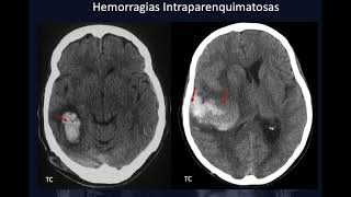 HEMORRAGIAS INTRACRANEALES