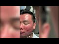 plasma pen sebaceous hyperplasia male skin resurfacing west hollywood ca dr. jason emer