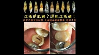 這樣還能補？還能這樣補！__根管治療 首重防裂 先補後抽 兼顧換藥 避做牙套（1080P）