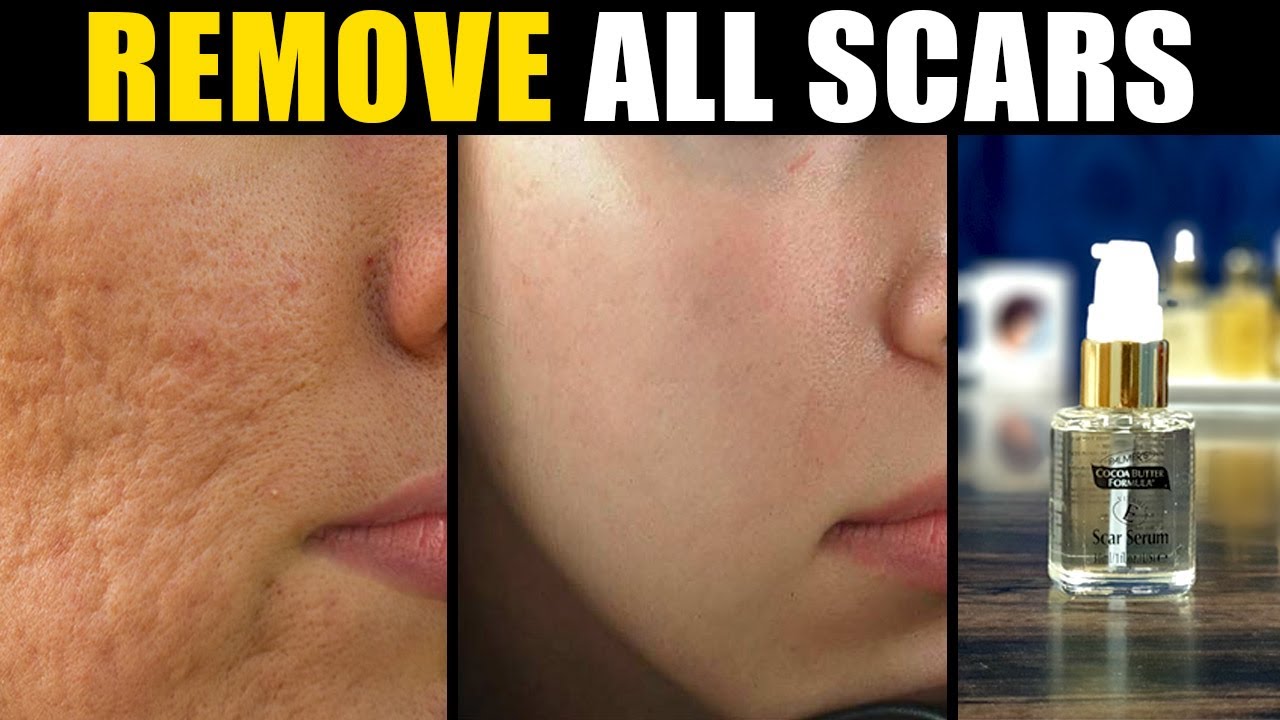 Remove All Types Of Scars With Medicated Scar Serum Acne Scars As Well ...