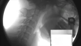 Severe Sagittal Plane C1-C2 Instability Due to Transverse Ligament Rupture