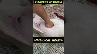 Umbilical hernia l dr umar khan