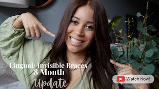 Lingual Braces 8 Month Update “InBrace\