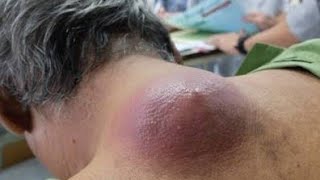 Gigantic painful abscess on back Inscission \u0026 drained || copious amounts of ruptured cyst expressed