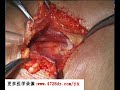 气管切开术tracheotomy