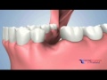 extraction ridge preservation and socket grafting with alveolar ridge preservation in bangkok 3d