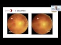 uveitis webinar 30 glaucoma in uveitis