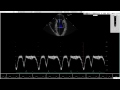 heartworks introduction to doppler features