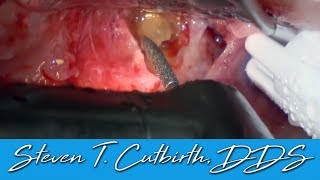 Apicoectomy of Infected Tooth with PRF \u0026 Phlebotomy