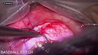 Transconjunctival optic nerve sheath fenestration: indications, technique and outcomes