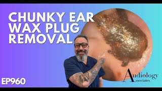 CHUNKY EAR WAX PLUG REMOVAL - EP960