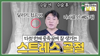 [운동선수 수술 케이스] 반복적으로 사람을 괴롭히는 스트레스 골절💦｜스트레스 골절 케이스｜수술 읽어주는 남자👨‍⚕️