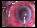 Sharp sight  centres,  small pupil cataract surgery- by Dr kamal Kapoor