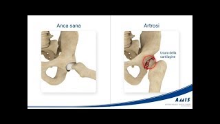 AMIS – LA SOLUZIONE MEDACTA (video informativo per i pazienti in italiano)