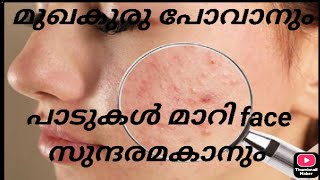 മുഖകുരു (pimple) കറുത്ത പാടുകൾ.. ഒറ്റ ദിവസം മതി മാറ്റിയെടുക്കാം...