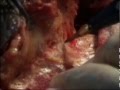 GND- Ilio Inguinal Block Dissection with Vein Graft  and Skin Cover- Dr Rajnish Talwar Surg Video