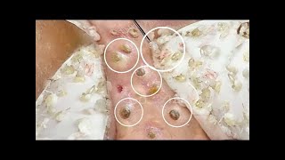 Remove Pimple Popping Blackhead Satisfying, Enjoy! The BEST OF Softpops! Dr Pimple Popper. Milia EP5