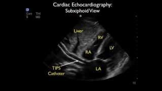 Transjugular Intrahepatic Portosystemic Shunt Migration to the Heart Diagnosed by ED Ultrasound