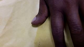 Clubbing of Finger Nails || Clubbed Nails in Respiratory Diseases