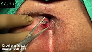 Fastest Laser Surgery For Bleeding Hemorrhoids with External Thrombosis in 3Mins by Dr Ashwin Porwal