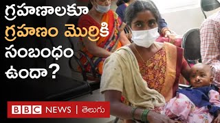 Cleft Lip: తిరుపతి BIRRD ఆస్పత్రిలో ఉచితంగా 'గ్రహణం మొర్రి' ఆపరేషన్లు, అసలు ఏంటిది? | BBC Telugu