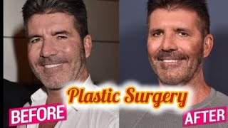 Simon Cowell Plastic Surgery alterations of Eyelid and facials