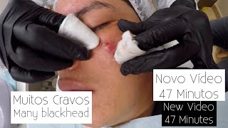 Blackheads Pimples - PART 3 Pele com muita Acne Limpeza de Pele Profunda - Doutora Acne Renata Lima