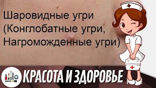 Шаровидные угри (Конглобатные угри, Нагроможденные угри)