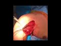 chronic pectoralis major tendon repair dr steve mora