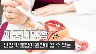 난임과 불임의 원인! I 자궁내막증 I 을지대학교병원 산부인과 교수 김승현 I 건강플러스