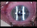 lasik with nidek ec5000 laser