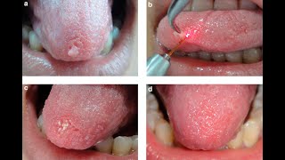 An Unusual Case of Leaf-like Traumatic Fibroma in a Dentate Patient