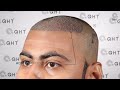 hair transplant in bangalore best results u0026 cost of hair transplant in bangalore