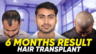 Hair Transplant in Bangalore | Best Results \u0026 Cost of Hair Transplant in Bangalore