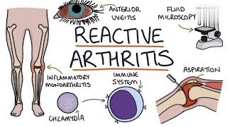 Reactive-Arthritis - (symptoms & Test)