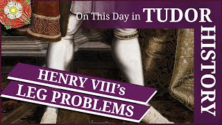 May 14 - Henry VIII's leg problems