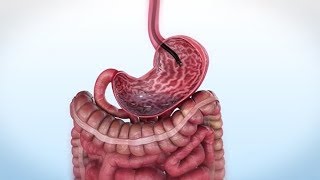 Endoscopic Sleeve Gastroplasty (ESG) Q&A with Dr. Victoria Gomez
