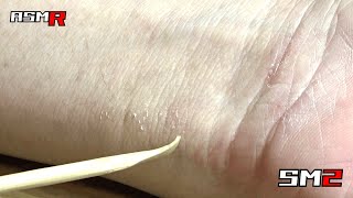 [eczema ASMR] The sound of scratching an itchy wrist with an earpick/healing/relaxing effect/massage