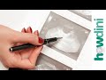 Ovarian cancer symptoms - Recognizing ovarian cancer signs Ovarian cancer symptoms - Recognizing ovarian cancer signs