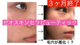 ゼオスキンセラピューティック終了！毛穴が悪化！？ダウンタイムが辛い！【肌管理】【シミ】【色素沈着】前編