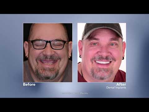 Replacing Missing Teeth with Dental Implants with Lafayette, Colorado Dentist James Martin, DMD